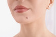 Young woman with birthmark in clinic, closeup view. Visiting dermatologist