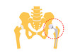 Total hip replacement. Vector illustration.