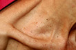 © timonina - Neck and collarbone in papillomas. Papilloma on the skin.