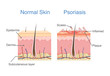 Normal skin layer and skin when plaque psoriasis signs and symptoms appear. illustration about dermatology diagram.