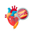 © marina_ua - Coronary artery disease concept in flat style