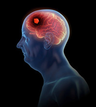 Illustration Of A Brain Tumor