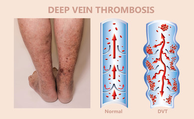 Wall Mural - Economy class syndrome mechanism, deep vein thrombosis or DVT, Pulmonary Embolism, coronary thrombosis, diagram