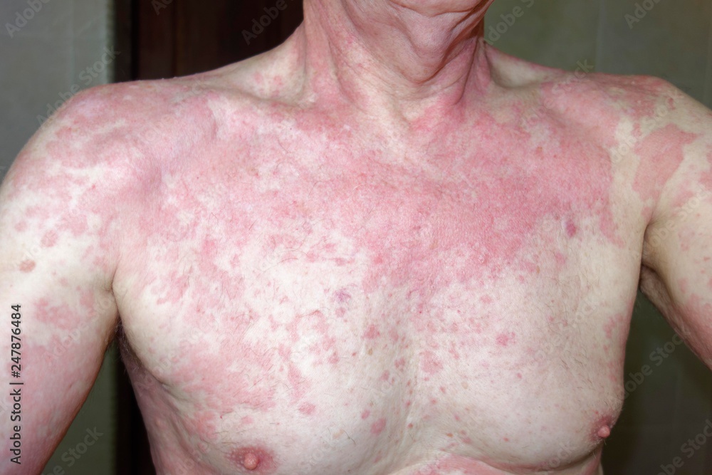 Man, 68 years old, with allergic reaction, skin rash, allergy, to ...