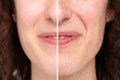 © Alessandro Grandini - Rappresentation of woman hal face with dry skin, before and after beauty treatment