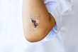 wound have scab on the elbow of the child