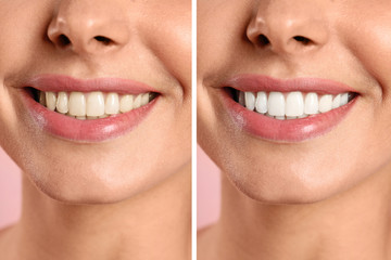 Wall Mural - Smiling woman before and after teeth whitening procedure, closeup