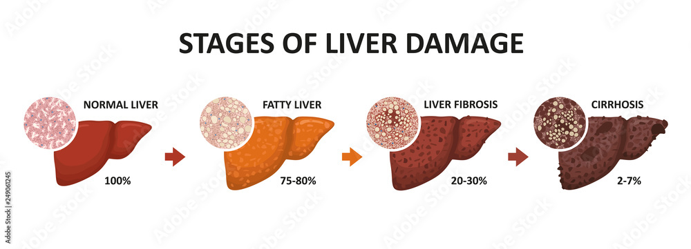 Stages of liver damage. Healthy, fatty, liver fibrosis and cirrhosis. - obrazy, fototapety, plakaty 