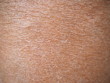 Dry skin (ichthyosis) texture detail on leg women using for skincare and moisturizer lotion, cream or cosmetics product concept.