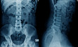 © angkhan - x-ray image of spine