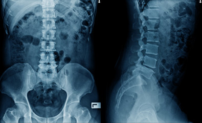 Wall Mural - x-ray image of spine