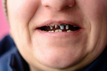 Close-up Of A Woman's Face With Rotten And Dying Teeth