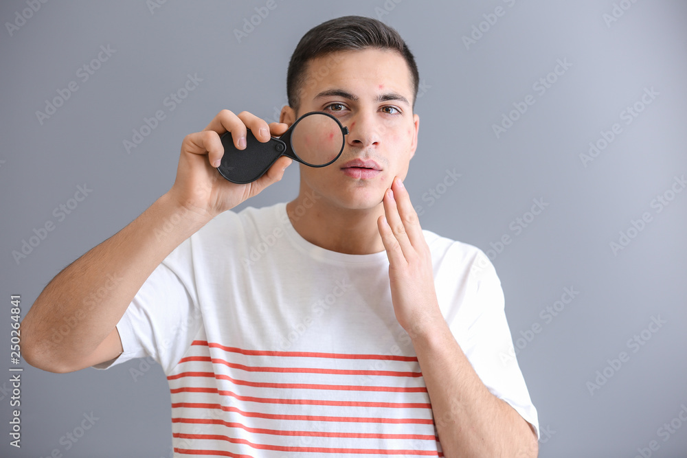 Portrait of young man with acne problem and magnifier on grey background