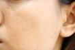 © TANIDA - close up wide pores on oily face skin of asia woman