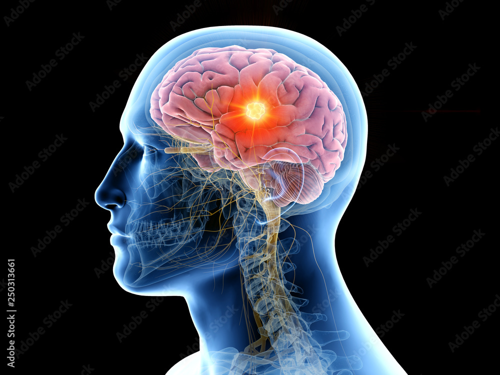 3d rendered medically accurate illustration of the human brain and a tumor - obrazy, fototapety, plakaty 
