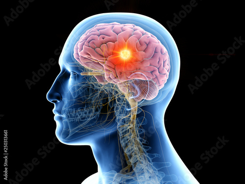 Cuadros en Lienzo 3d rendered medically accurate illustration of the human brain and a tumor