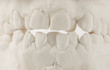 Dental casting gypsum model of human jaws. Crooked teeth and distal bite. Shots were made before treatment with braces . Technical shots on gray background