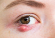 © Beetroot Studio - Eyelid abscess. Close up photo of young caucasian woman barley brown eye infection, eyelid abscess, stye, hordeolum. Concept of health, disease and treatment.