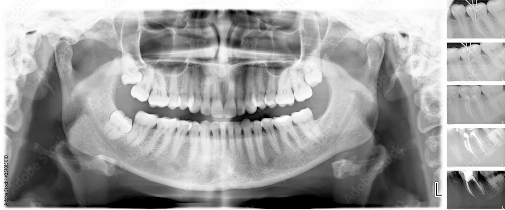 Teeth Roots X Ray X-Ray scan of human teeth for analyzing and treating with stages of ...