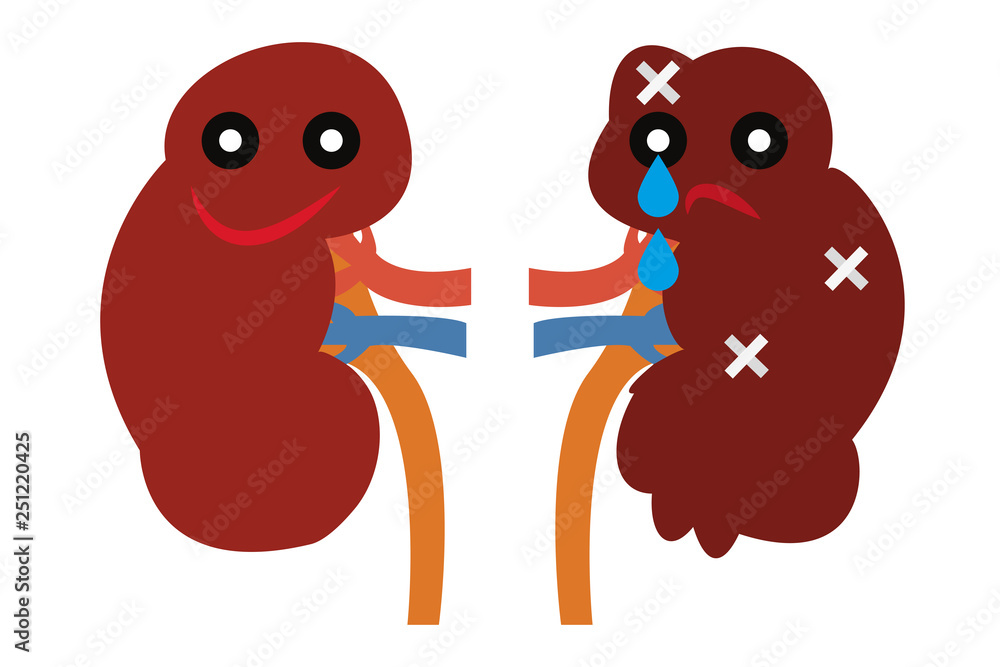 Riñón sano y riñón enfermo. Stock Vector | Adobe Stock