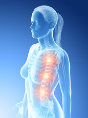 Wall Mural - 3d rendered illustration of a females painful spine