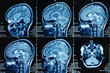 Photograph of magnetic resonance imaging of human brain in sagittal plane. The study use for diagnosis brain tumor  or vertigo