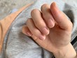 © Gohan T - The fingers of the woman are dry The nail edge is flaky, Should be applied to the cream, Dry skin allergy