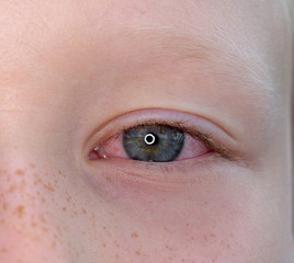 One eye of a teenager with conjunctivitis, macro closeup