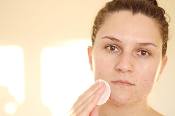 Acne on the face of young women. Improper therapy has led to a severe form of chronic inflammation face