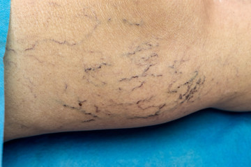 Close up of human varicose spider veins on leg