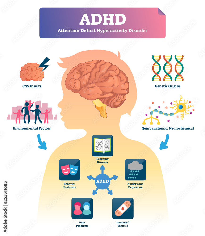 ADHD vector illustration. Labeled mind attention deficit disorder scheme. - obrazy, fototapety, plakaty 