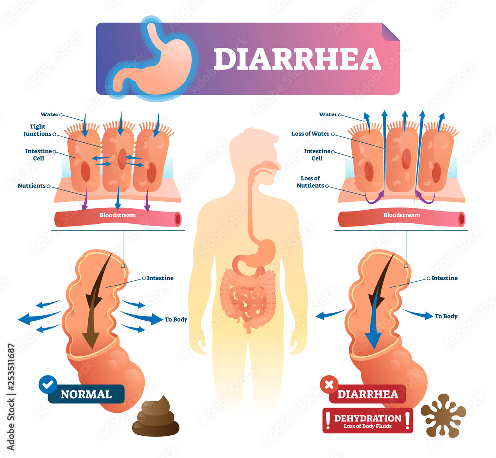 Diarrhea vector illustration. Labeled stomach gut illness medical ...