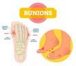 © VectorMine - Bunions vector illustration. Labeled feet bone disorder explanation scheme.
