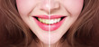 © Vero - Bleaching of teeth. Before and after.