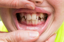 Crooked Teeth That Need To Be Fixed And Straightened Using Braces