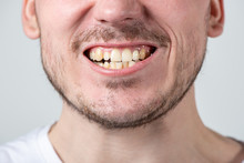 A Man With Bristles And An Open Mouth With Uneven Teeth