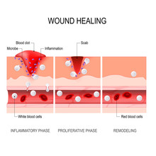 Wound Healing Process. Tissue Injury And Inflammation.