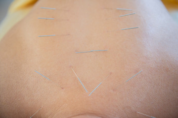 close up detail of acupuncture needles in back neck