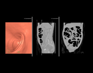 Sticker - CT colonography or CT Scan of Colon 3D rendering image comparison with sagittal view vs Coronal view and on the screen.