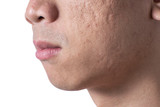 Fototapeta  - Close-up acne and scars on asian man face, isolated white background