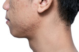 Fototapeta  - Close-up acne and scars on asian man face, isolated white background