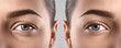 Woman before and after blepharoplasty procedure, closeup. Cosmetic surgery