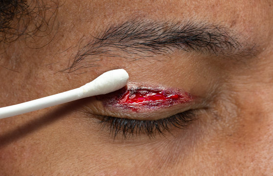 Medication of human eyelid with disinfectant in a swab