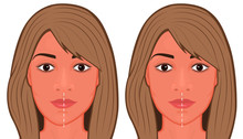 Vector Illustration Of A Jaw Asymmetry Correctiom Surgery. For Advertising Of Plastic Surgery, Medical And Beauty Publications