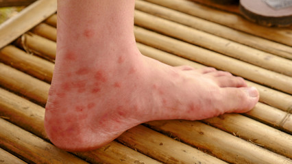 Close up red rash of man’s feet