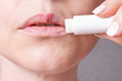 © Sviatlana - part of a woman's face , herpes on the lips, beauty concept