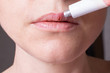 © Sviatlana - Herpes on the lips of the young woman . Woman lubricates the labial herpes ointment