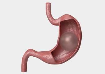 Balloon gastric. inflatable device that is placed in the stomach to reduce weight