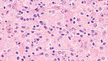 Microscopic Image Of Disseminated Histoplasmosis, A Type Of Fungal Infection Caused By The Fungus Histoplasma Capsulatum,  The Yeast Forms Appear As Small Dots Within The Cytoplasm Of Macrophages. 