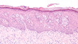 Breast Cancer Awarness: Paget's Disease of the breast (nipple) is usually associated with ductal carcinoma in situ (DCIS). Malignant cells extent into epidermis of skin, giving an eczema-like rash.
